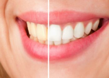 Teeth Whitening 101: What Families Should Know
