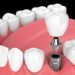 Are Dental Implants Right For You? A Comprehensive Guide