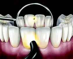 3 Reasons Fiber‑Optic Transillumination Is Revolutionizing Cavity Detection